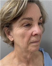 Facelift Before Photo by Franklin Richards, MD; ,  - Case 50893