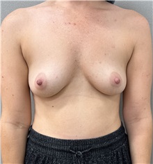 Breast Augmentation Before Photo by Franklin Richards, MD; ,  - Case 50892