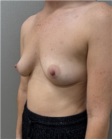 Breast Augmentation Before Photo by Franklin Richards, MD; ,  - Case 50892