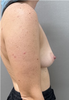 Breast Augmentation Before Photo by Franklin Richards, MD; ,  - Case 50892