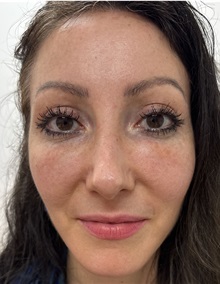 Brow Lift After Photo by Franklin Richards, MD; Bethesda, MD - Case 51390