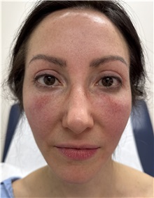 Brow Lift Before Photo by Franklin Richards, MD; Bethesda, MD - Case 51390