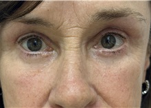 Eyelid Surgery After Photo by Franklin Richards, MD; Bethesda, MD - Case 51487
