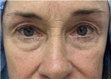 Eyelid Surgery Before Photo by Franklin Richards, MD; Bethesda, MD - Case 51487