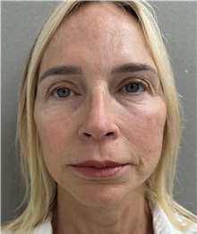 Facelift After Photo by Franklin Richards, MD; Bethesda, MD - Case 51491