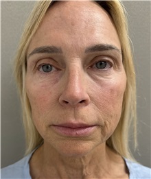 Facelift Before Photo by Franklin Richards, MD; Bethesda, MD - Case 51491