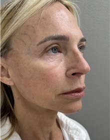 Facelift After Photo by Franklin Richards, MD; Bethesda, MD - Case 51491
