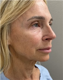 Facelift Before Photo by Franklin Richards, MD; Bethesda, MD - Case 51491