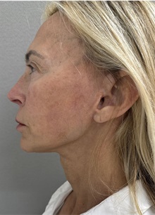 Facelift After Photo by Franklin Richards, MD; Bethesda, MD - Case 51491