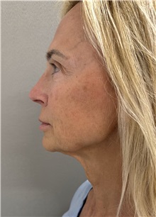 Facelift Before Photo by Franklin Richards, MD; Bethesda, MD - Case 51491