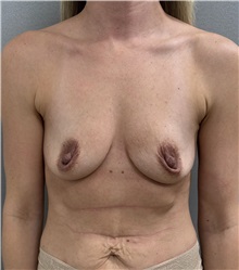 Breast Augmentation Before Photo by Franklin Richards, MD; Bethesda, MD - Case 51492