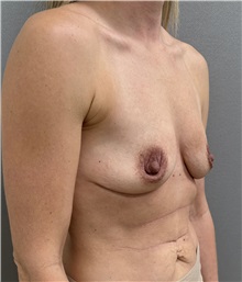 Breast Augmentation Before Photo by Franklin Richards, MD; Bethesda, MD - Case 51492