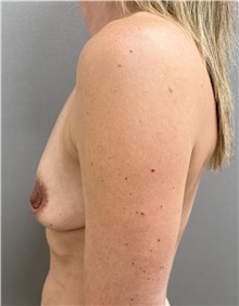 Breast Augmentation Before Photo by Franklin Richards, MD; Bethesda, MD - Case 51492