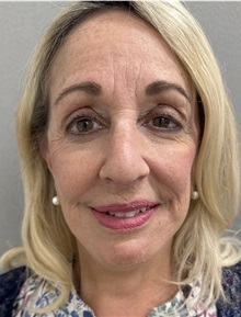 Facelift After Photo by Franklin Richards, MD; Bethesda, MD - Case 51493