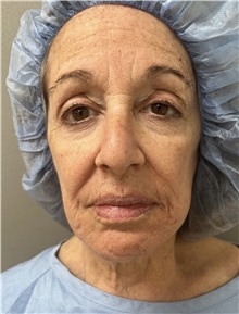 Facelift Before Photo by Franklin Richards, MD; Bethesda, MD - Case 51493