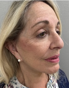 Facelift After Photo by Franklin Richards, MD; Bethesda, MD - Case 51493