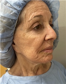 Facelift Before Photo by Franklin Richards, MD; Bethesda, MD - Case 51493