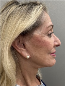 Facelift After Photo by Franklin Richards, MD; Bethesda, MD - Case 51493