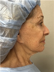 Facelift Before Photo by Franklin Richards, MD; Bethesda, MD - Case 51493