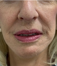 Laser Skin Resurfacing After Photo by Franklin Richards, MD; Bethesda, MD - Case 51494