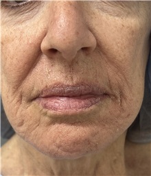 Laser Skin Resurfacing Before Photo by Franklin Richards, MD; Bethesda, MD - Case 51494