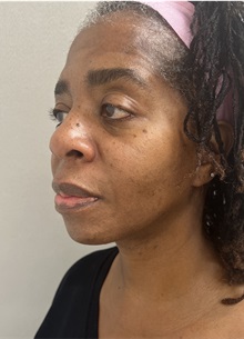 Facelift After Photo by Franklin Richards, MD; Bethesda, MD - Case 49330