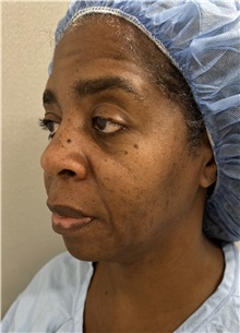 Facelift Before Photo by Franklin Richards, MD; Bethesda, MD - Case 49330