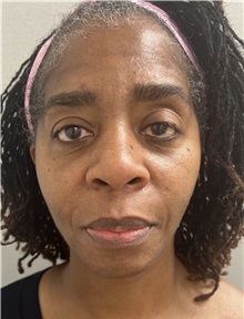 Facelift After Photo by Franklin Richards, MD; Bethesda, MD - Case 49330