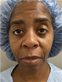 Facelift Before Photo by Franklin Richards, MD; Bethesda, MD - Case 49330