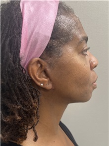 Facelift After Photo by Franklin Richards, MD; Bethesda, MD - Case 49330