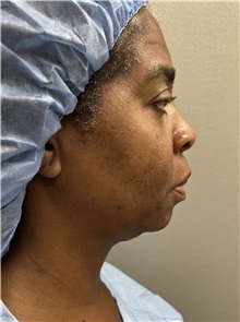 Facelift Before Photo by Franklin Richards, MD; Bethesda, MD - Case 49330