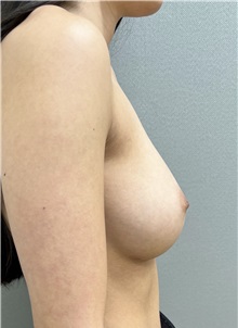 Breast Augmentation After Photo by Franklin Richards, MD; Bethesda, MD - Case 49441