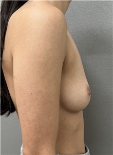 Breast Augmentation Before Photo by Franklin Richards, MD; Bethesda, MD - Case 49441