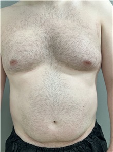 Liposuction Before Photo by Franklin Richards, MD; Bethesda, MD - Case 49717 Liposuction Before Photo by Franklin Richards, MD; Bethesda, MD - Case 49717