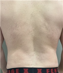 Liposuction After Photo by Franklin Richards, MD; Bethesda, MD - Case 49717