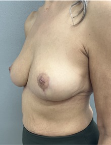 Breast Reduction After Photo by Franklin Richards, MD; Bethesda, MD - Case 49718