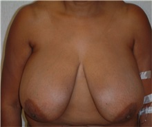 Breast Reduction Before Photo by Franklin Richards, MD; Bethesda, MD - Case 49721