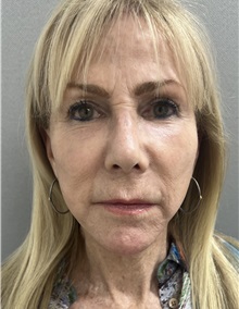 Facelift After Photo by Franklin Richards, MD; Bethesda, MD - Case 49968