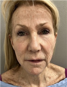 Facelift Before Photo by Franklin Richards, MD; Bethesda, MD - Case 49968
