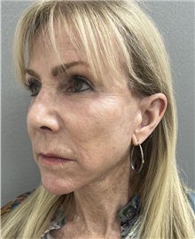 Facelift After Photo by Franklin Richards, MD; Bethesda, MD - Case 49968