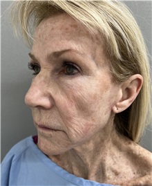 Facelift Before Photo by Franklin Richards, MD; Bethesda, MD - Case 49968