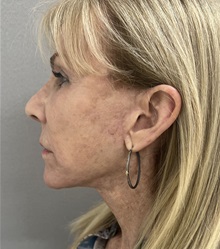 Facelift After Photo by Franklin Richards, MD; Bethesda, MD - Case 49968