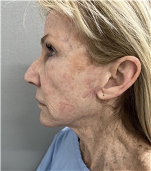 Facelift Before Photo by Franklin Richards, MD; Bethesda, MD - Case 49968