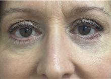 Eyelid Surgery After Photo by Franklin Richards, MD; Bethesda, MD - Case 50065