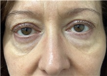Eyelid Surgery Before Photo by Franklin Richards, MD; Bethesda, MD - Case 50065