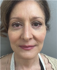 Facelift After Photo by Franklin Richards, MD; Bethesda, MD - Case 50066 Facelift After Photo by Franklin Richards, MD; Bethesda, MD - Case 50066