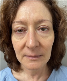 Facelift Before Photo by Franklin Richards, MD; Bethesda, MD - Case 50066 Facelift Before Photo by Franklin Richards, MD; Bethesda, MD - Case 50066