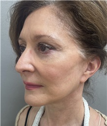 Facelift After Photo by Franklin Richards, MD; Bethesda, MD - Case 50066