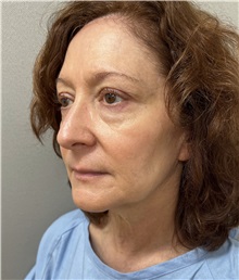Facelift Before Photo by Franklin Richards, MD; Bethesda, MD - Case 50066