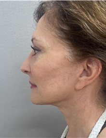 Facelift After Photo by Franklin Richards, MD; Bethesda, MD - Case 50066